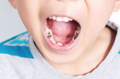 Tại sao phải trám răng sữa